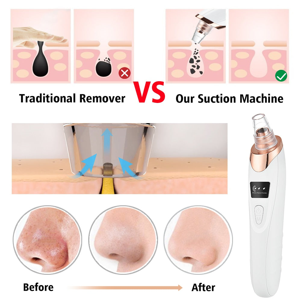 Blackhead Remover Vacuum – Electric Facial Pore Cleaner